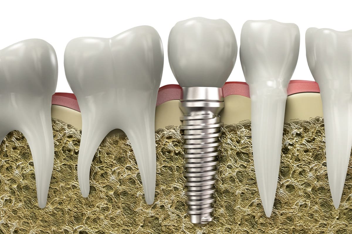 dental implant care 101 essential tips for optimal maintenance