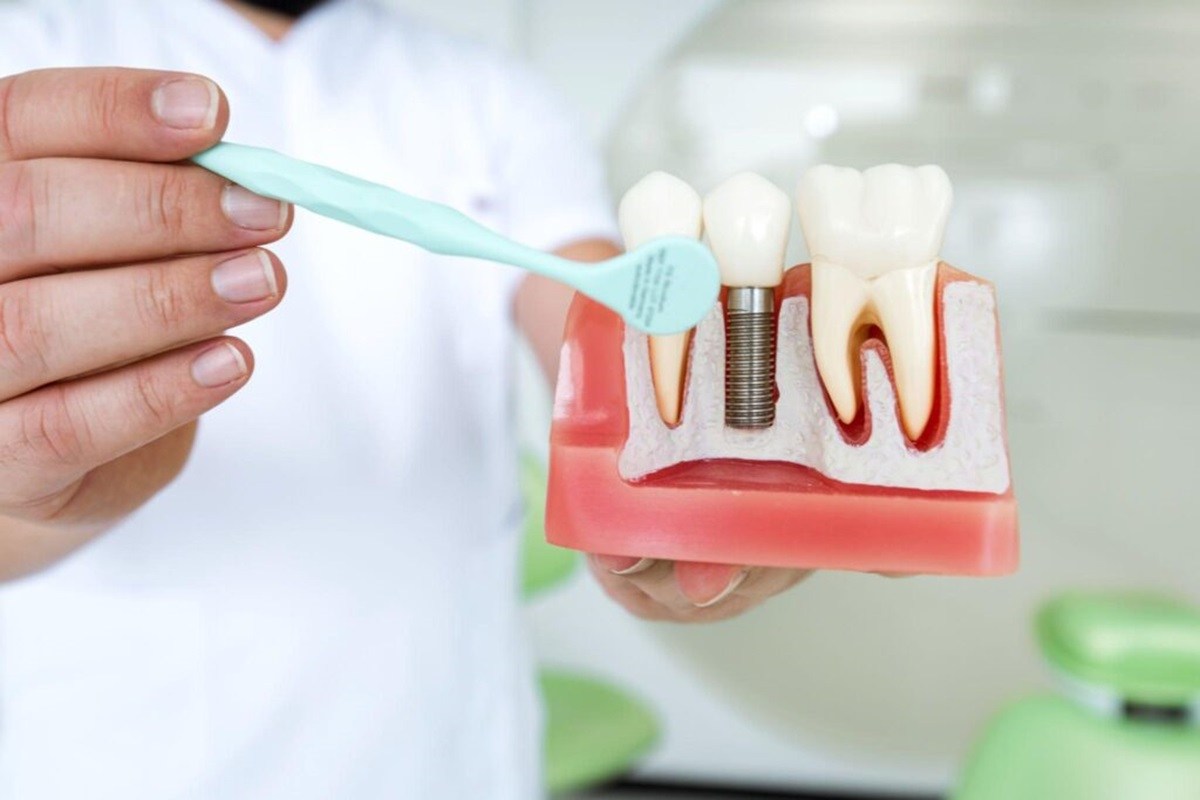 choosing between dental bridges and implants what to know