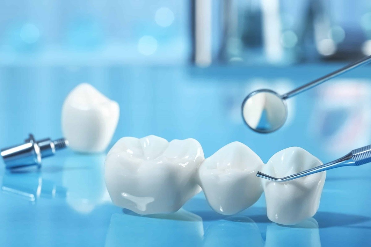 the 4 most common types of dental bridges