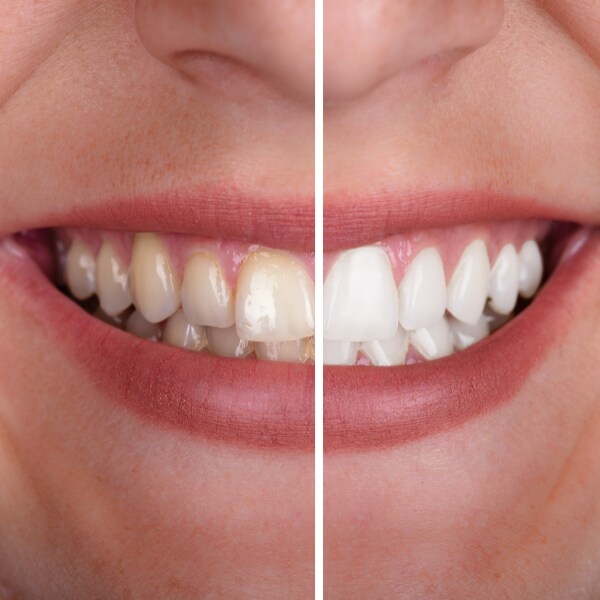 5 natural teeth whitening techniques you can try at home